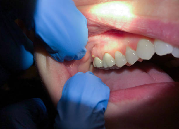 Best Emergency Denture Repair in Chandler, OK
